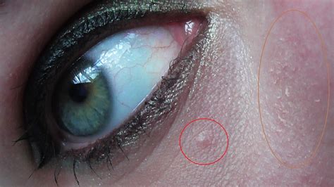 Blaufärbung der haut und der schleimhäute. Helft mir! Concealer oder Creme? | Jenseits von Eden