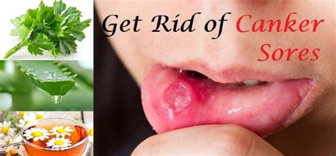 Remedies For Canker Sore On Tongue