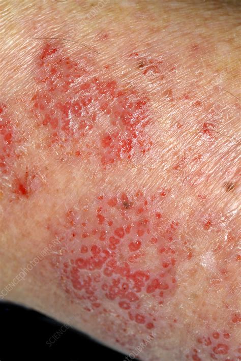 Dermatitis Stock Image C0263291 Science Photo Library