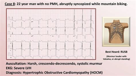 Ekg And Heart Murmur Review Part 2 Youtube