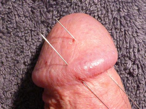 CBT Acupuncture Needles ThisVid Com