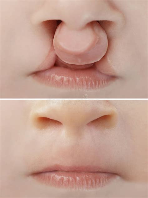Cleft Palate Surgery Stock Photos Free And Royalty Free Stock Photos