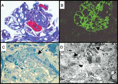 Thin basement membrane disease (tbmd, also known as benign familial hematuria and thin basement membrane nephropathy or tbmn) is, along with iga nephropathy, the most common cause of hematuria without other symptoms. Diagnosis of immunoglobulin A (IgA) anti- glomerular ...
