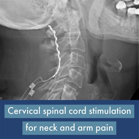 Spinal Cord Stimulation — Matthew Mian Md