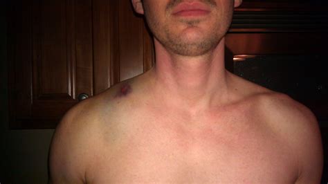 In particular, you might not know that you have (metastatic) bone. Chad's Broken Clavicle | Sweep Tight