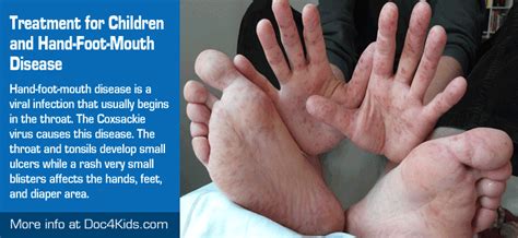 Treatment For Children And Hand Foot Mouth Disease