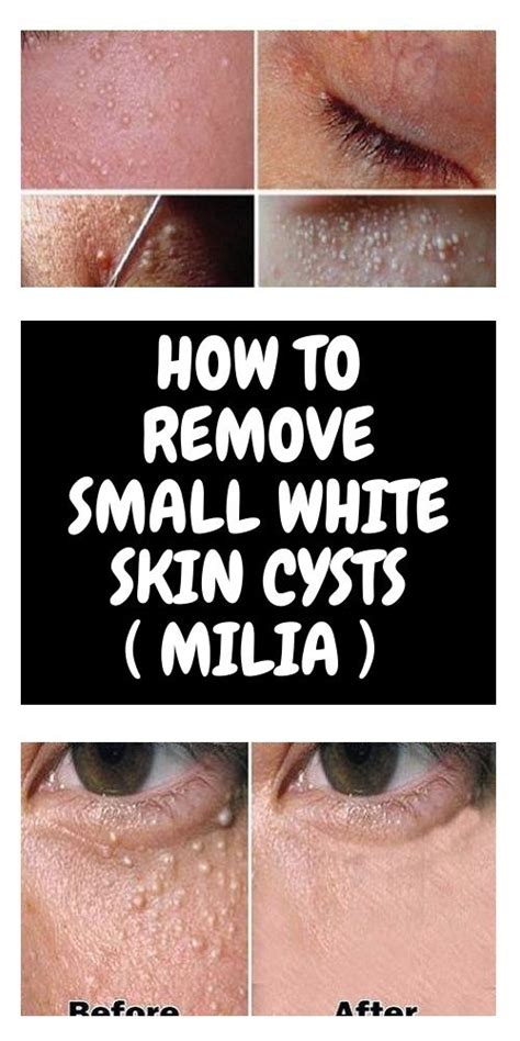 MILIA HOW TO REMOVE THE SMALL WHITE SKIN CYSTS Skin Cyst Whiter Skin How To Remove