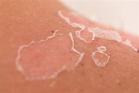 Skin Peeling After Sunburn Stock Image Image Of Close 152123435
