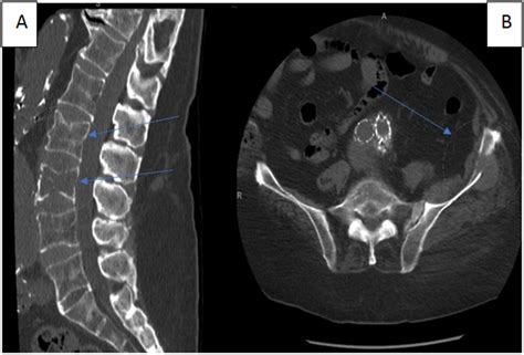 Figure 1 Ct Scan Of The Lumbar Spine A And Hip B Showing