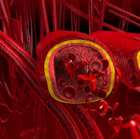 This clot can block or obstruct blood flow in the affected area. Thromboses et néoplasies myéloprolifératives | Cardiologie ...