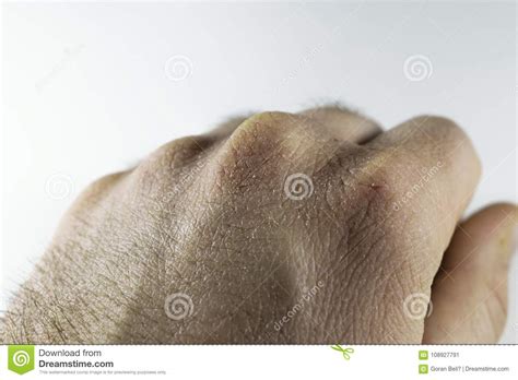 Close View Of Dry And Cracked Hand Knuckles Skin Problem Stock Image
