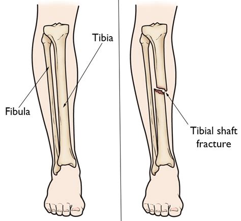 Nonunion Tibia Fracture And Its Treatment Vasudeva