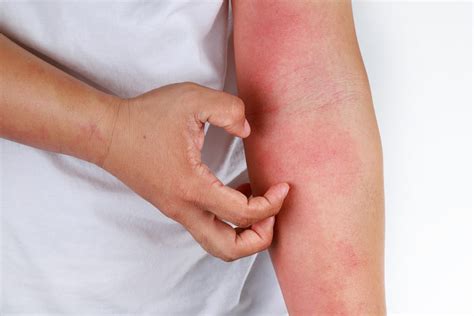 Dermatite Atopica Significato Nei Bambini Cause E Rimedi