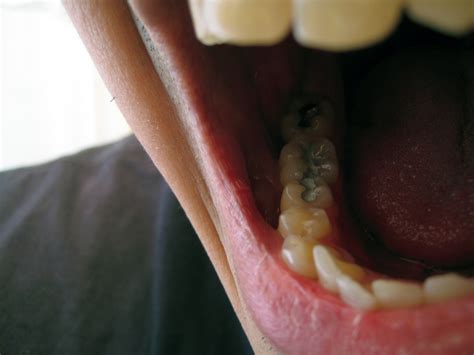 how long should a cavity filling be sensitive dental health society 2023