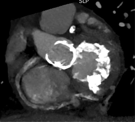 Computed Tomographic Scan Showing A Heavily Calcified Mitral Annulus