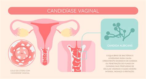 Corrimento Vaginal Scope Ginecologia