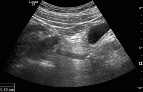 Distal Vuj Stone Case 2 • Litfl • Ultrasound Clinical Cases