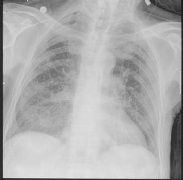 Treatment and cure for bilateral pleural effusions. CT axial image at the level of T10 demonstrating bilateral ...
