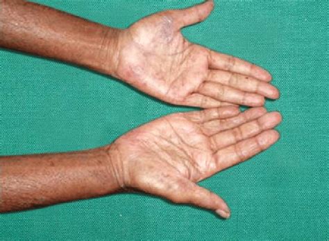 Maculopapular Rashes Seen On The Palms Of The Patient Download
