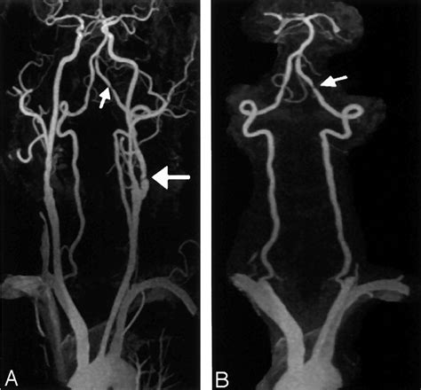 Contrast Enhanced Mr Angiography Of The Carotid And Vertebrobasilar