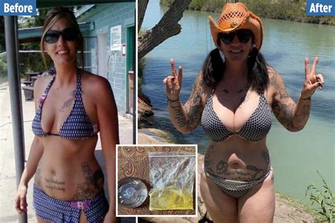 Mom Went Blind Deaf And Lost Her Hair When Leaking 10k Breast Implant
