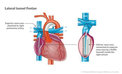 Cardiology Information For Patients And Parents About The Fontan
