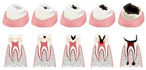 What Does A Cavity Look Like Smile Makeover Of La