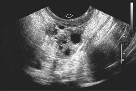 Transvaginal Ultrasound Scan From A Patient With Spontaneous 46xx