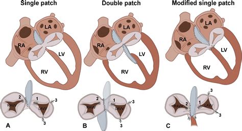 Atrioventricular Septal Defect From Embryonic Development To Long Term