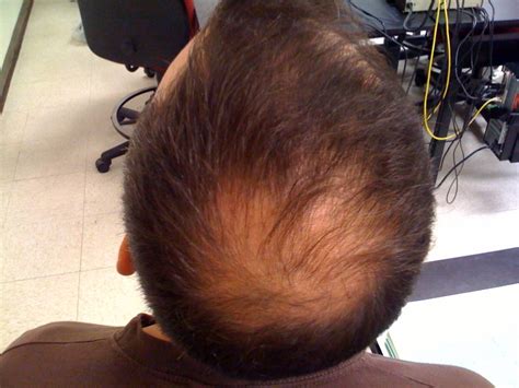 Circulation and hair loss is a popular and yet controversial topic. How Bad Blood Circulation Can Cause Hair Loss In Men?