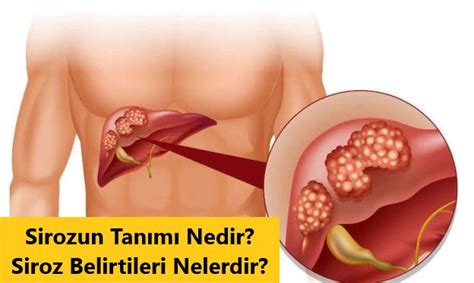 Sirozun Tanımı Nedir Siroz Belirtileri Nelerdir edoktorTV