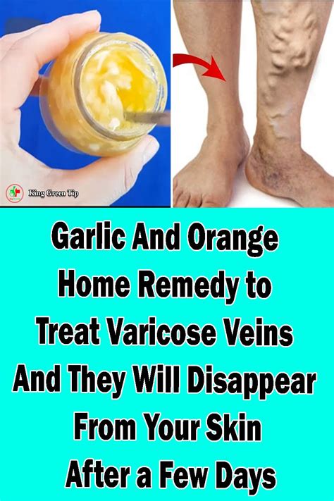 Pin On How To Treat Varicose Veins