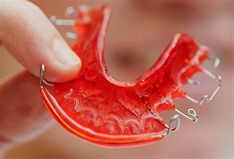 Pin By John Beeson On Orthodontic Retainers Orthodontic Appliances Orthodontics Retainers