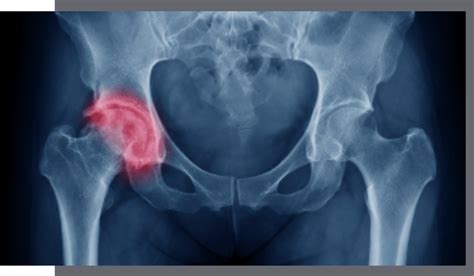 Snapping Hip Syndrome Guide Easthill Physiotherapy And Acupuncture