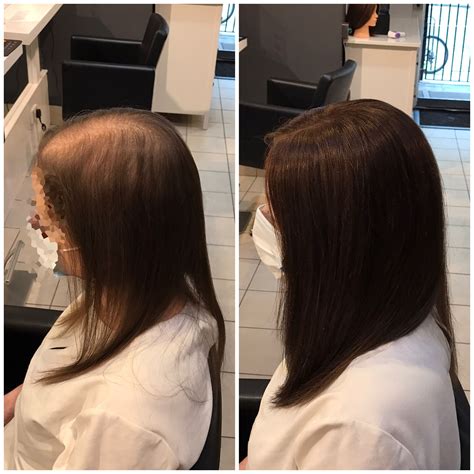 Towel drying hair will expand its volume around the crown, thus hiding the scalp easily. CROWN VOLUMISER | Hair loss specialists Edinburgh