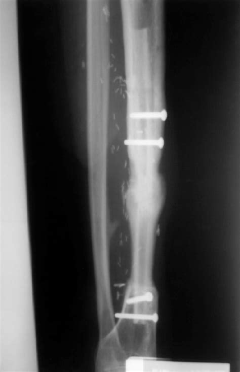 Figure From Composite Vascularised Osteocutaneous Fibula And Sural