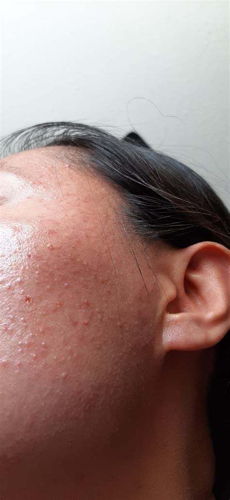 Skin Concerns Hard Bumpy Texture On Face Rskincareaddiction