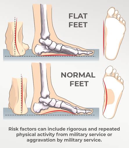 We did not find results for: VA Disability Ratings for Flat Feet - Hill & Ponton, P.A.