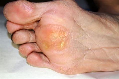 All You Need To Know About Painful Corns And Callous Procare Podiatric