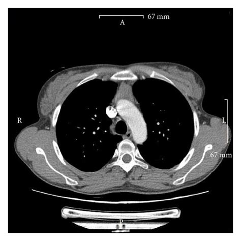 Thorax ct scan with soft tissue window setting. CT scan of the thorax showing the enlarged mediastinal ...