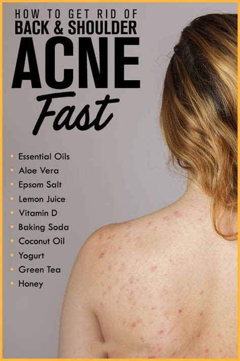 Get Rid Of Back And Shoulder Acne Tratamiento Natural Del Acné