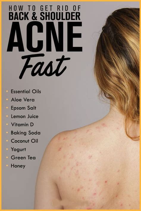 Get Rid of Back And Shoulder Acne | Tratamiento natural del acné