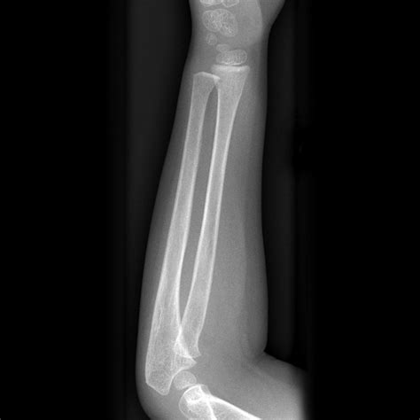 Buckle Fracture Image
