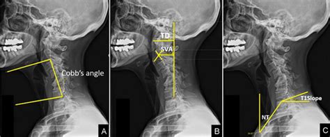 Correlation And Reliability Of Cervical Sagittal Alignment Parameters