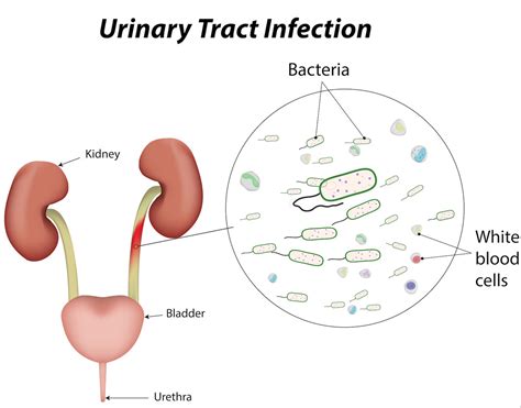 Do You Suffer From Urinary Tract Infections Austrials Website