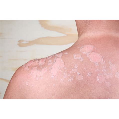 Reasons For Purplish Skin On The Neck Area Healthfully