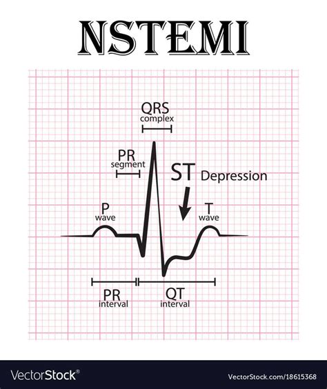 In the process, the nurse gauges patient progress, is mindful of recurrent myocardial ischemia and alerts others to its presence, identifies complications of thrombolytic therapy and ptca, is alert to potentially malignant rhythm disturbances, and finally is the advocate of patient rehabilitation. ECG of non ST elevation myocardial infarction NSTEMI ...