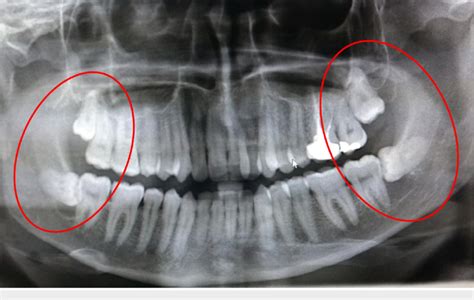 Panoramic Radiograph Showing Radiolucencies Compatible With Dentigerous