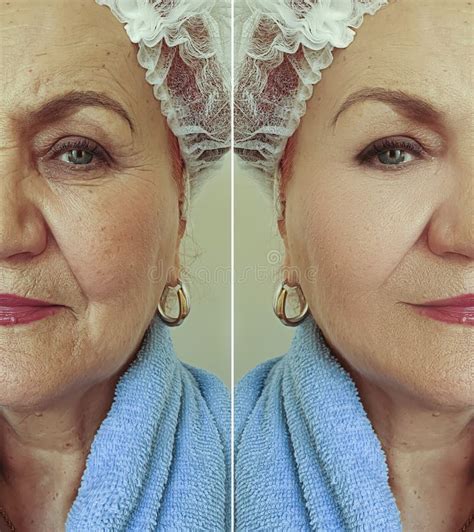Face Old Woman Wrinkles Before After Therapy Treatment Stock Photo