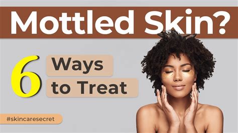 6 Simple Ways How You Can Treat Your Mottled Skin Causes And